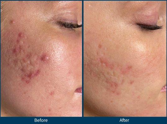 Microneedling