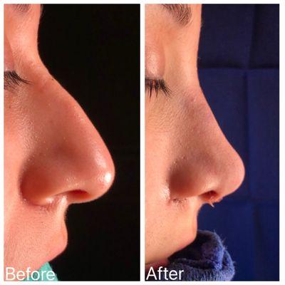 Before/after rhinoplasty