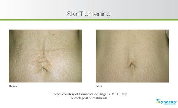 Skin Tightening