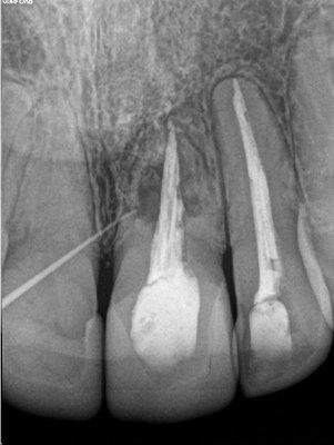 the black mass is the infection that caused the tooth to be extracted