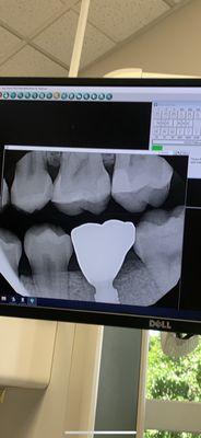 Bone levels before the implant did the damage.