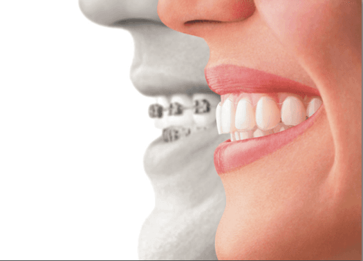 Invisalign Clear Aligners