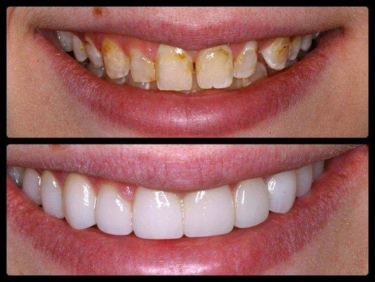 Smile MakeOver Before-After