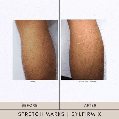 Stretch Marks Sylfirm X