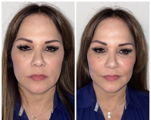 Before/after restylane Lyft