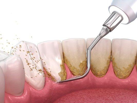 Having a consistent dental care will prevent many disease, deep cleaning is necessary to keep a healthy dental hygiene.