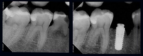 Removal of an infected baby tooth and replacement with an implant on the same appointment