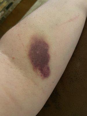 My bruised arm after MRI with Contrast at Envision Bedford day 4.