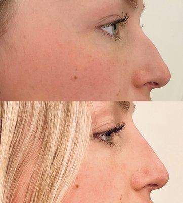 Before & After
 Liquid Rhinoplasty