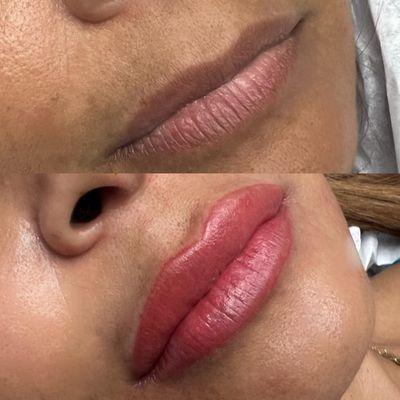 Lip contouring