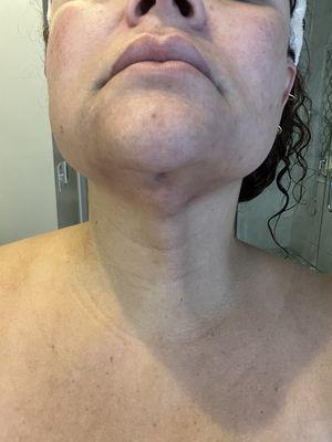 Scars -Six months after the first endolift & 3 months after 2nd attempt.