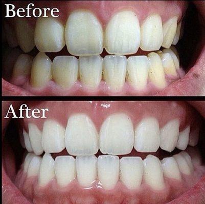 Before and after 1 hour Teeth Whitening