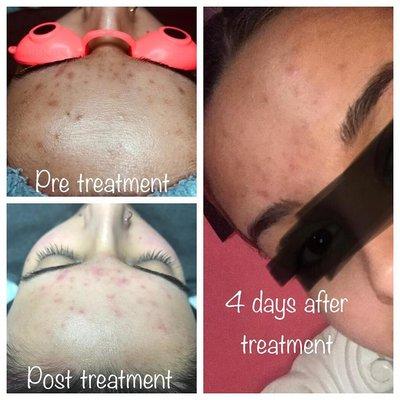 Acne doesn't stand a chance with Revival Esthetics!