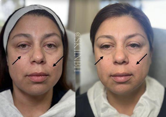 Morpheus8 and PRP for undereyes and smile lines