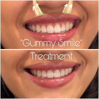 Gummy Smile Treatment