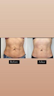 V-FORM Body Contouring