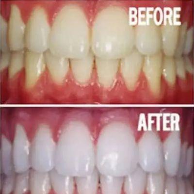 One 45 Minute teeth whitening session yielding instantly whiter teeth!