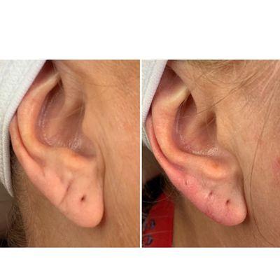 Ear line filler