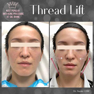 PDO Thread Lift  treatment gives you immediate lift up result.