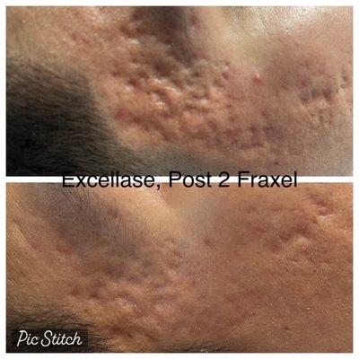 Acne scar improvement post two treatments at Excellase Raleigh