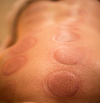 CUPPING