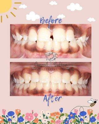 Get ready to be blossomed by this amazing orthodontic transformation!