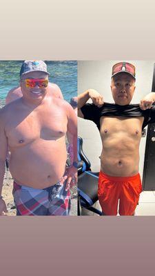 Incredible transformation with Semaglutide injections!  Way to go :)