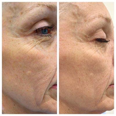 Dermaplaning before and after just one treatment.