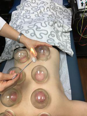 Fire Cupping  can help to detox your body, release muscle pain