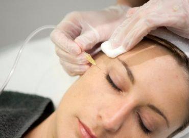 FACIALS REJUVENATION Carbon dioxide (CO2) application beneath the skin stimulates collagen production for younger skin.