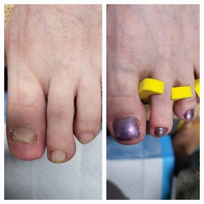 Toenail Reconstruction pedicure for damaged or injured nails