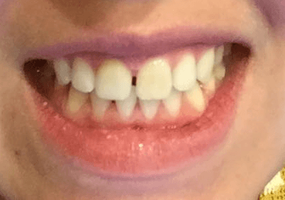 This is what the dentist did to my teeth. His assistant  claimed to like the 'gap' between my teeth. The tooth was too long and hurt my lip.