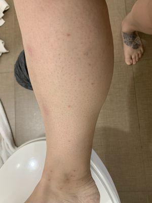 Bed bug bites