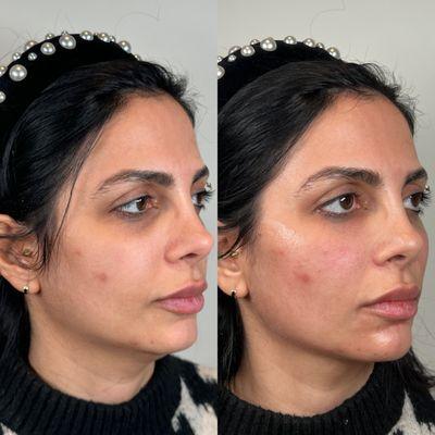 Full Face Rejuvenation