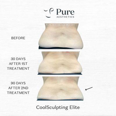 CoolSculpting at Pure Aesthetics