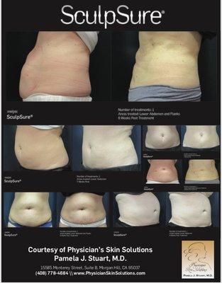 SculpSure-Amazing results after only one treatment.