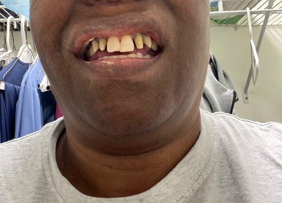 Before front teeth extraction and replacement