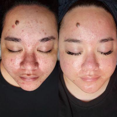 Before & after acne and brightening treatments.