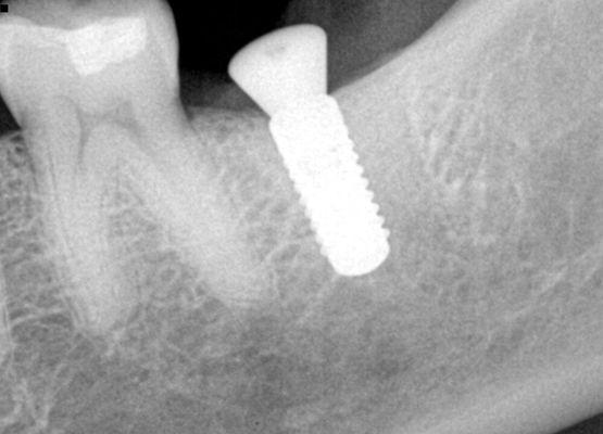 Single tooth implant replacing a molar tooth