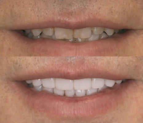 Smile makeover with porcelain Laminates