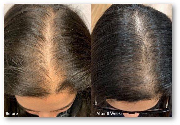 thinning hair restored with keralase