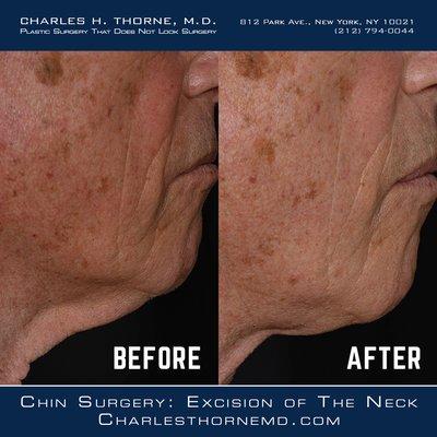 Chin Surgery: Excision of The Neck Before & After Images