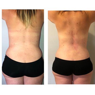 Before and after of back/love handle treatment