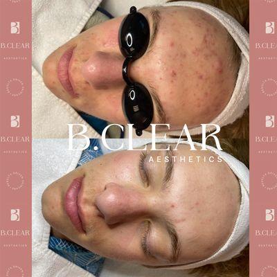 Before and After results from our Acne Treatment program