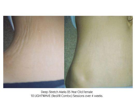 Stretch marks reduced with LED therapy.