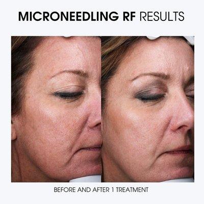 Results after one Virtue Microneedling RF treatment