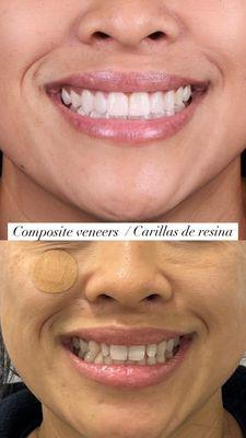 Veneers / Carillas