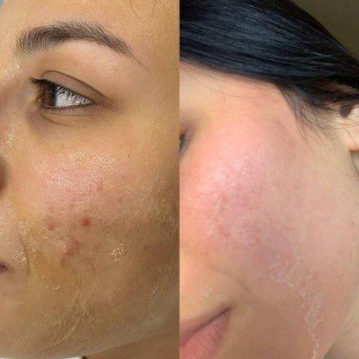 Great results from a chemical peel for acne prone skin! Photo on right is only three days later. Call now for 20% off a spring facial.