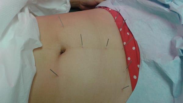 Acupuncture therapy