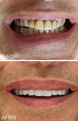 Before & After with Porcelain Veneers!